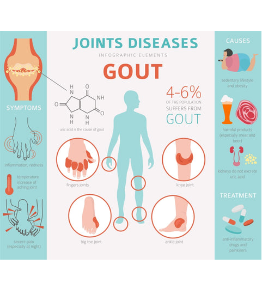 Iperuricemia: illustrazione sulle caratteristiche della gotta